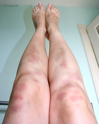 jambes pleines de bleus